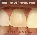 Picture of a tooth that has lost its porcelain veneer.