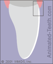 Animation showing the cement layer between a veneer and its tooth.