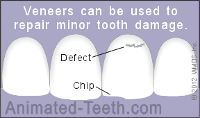 Animation showing how dental laminates can be used to repair minor tooth chips.