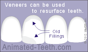 Animation showing how veneers can be used to resurface teeth.