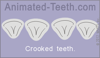 Animation showing how veneers can be used to 'straighten' the alignment of teeth.