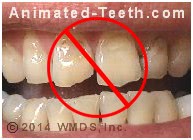 Graphic suggesting that of severely worn and broken teeth don't make good candidates for porcelain veneers.
