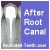 Dental work needed after root canal.