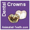 Dental crown vs. filling information.