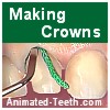 Dental crown procedure.