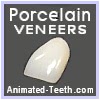 What are porcelain veneers?