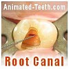 Root canal procedure steps.