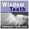 Paresthesia as a complication of wisdom tooth removal.