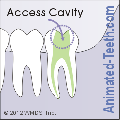 Diagram of where a tooth's access cavity is made.