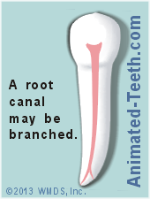 A branched root canal.