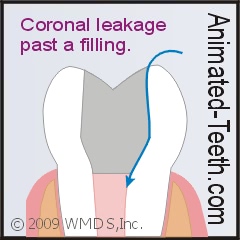 Link to diagram of dental restoration leakage.