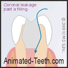 Coronal leakage - A situation where bacteria seep past a filling.