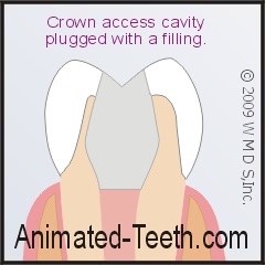 Placing a filling in an access made through a dental crown.