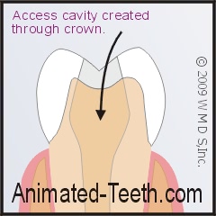 A dentist may make the access cavity right through the dental crown.
