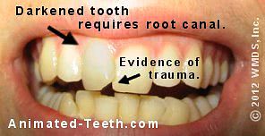 Link to root canal/darkened teeth section.