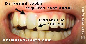 An individually darkened tooth.