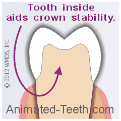 Dental cores aid crown stability.