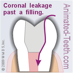 Coronal leakage - Bacteria seeping past a dental filling.