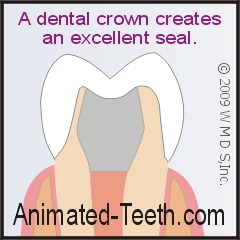A dental crown provides an excellent seal for a tooth that has had root canal treatment.