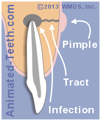 A diagram showing the component characteristics of a sinus tract.