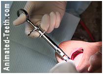 A picture of a dentist giving a dental injection.