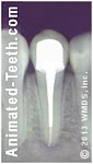 X-ray of a tooth that has received root canal treatment and dental post, core and crown.