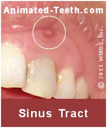 Picture of a dental sinus tract.