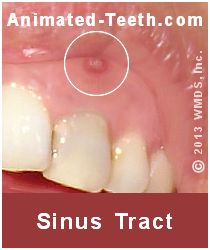 Link to indications of endodontic failure.