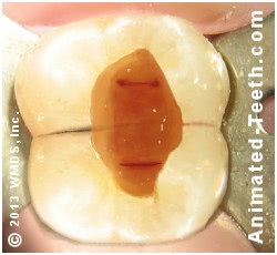 Picture of access endodontic access cavity in a molar.