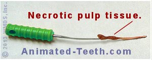Necrotic pulp tissue removed from a tooth.