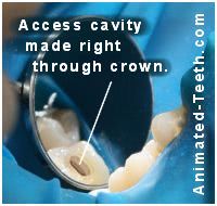 The access cavity for the tooth's treatment has been made right through the crown.