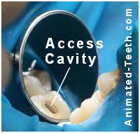 An access cavity in the chewing surface of a molar.