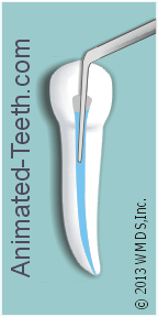 Graphic illustrating root canal irrigation.