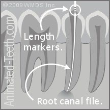 Graphic illustrating the measurement of the length of a root canal via x-ray.