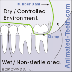 Diagram of a tooth with rubber dam in place.