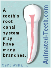 Animation showing root canal system cleansing via instrumentation and irrigation.