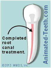 Diagram showing a tooth's sealed root canal space.