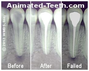 Series of x-rays showing before and after root canal treatment and then signs of root canal failure due to coronal leakage.