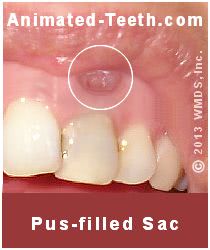 Picture of a dental fistulous tract whose orifice is slightly enlarged.
