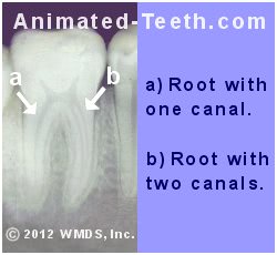 X-ray of molar having multiple root canals.