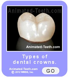 Learn about the different types of dental crowns.
