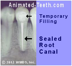 An x-ray showing a tooth's completed endodontic treatment and a temporary filling.