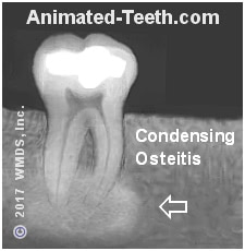 A tooth whose surrounding bone shows condensing osteitis.