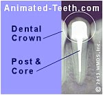 An x-ray showing completed treatment, post and core, and dental crown.
