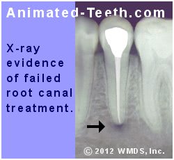An x-ray showing evidence of failed root canal treatment.