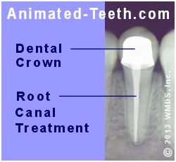 An x-ray showing completed endodontic therapy and a dental crown.