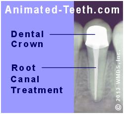 An x-ray image of a dental post and core.