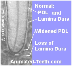 PDL and Lamina Dura changes on an x-ray that indicate root canal treatment is needed.