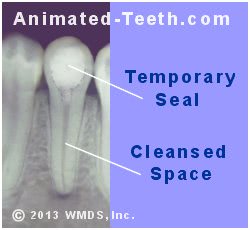 A temporary seal is placed in a tooth between root canal appointments.