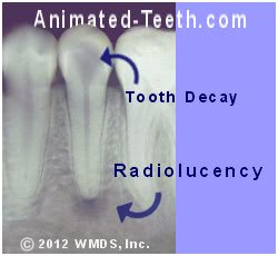An x-ray of a tooth needing treatment. A radiolucency is shown.